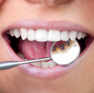 Lingual Braces