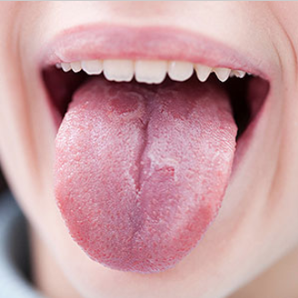 Tongue Condition