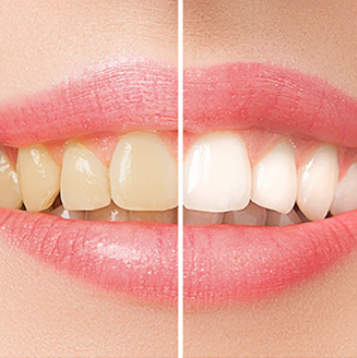 before and after teeth whitening