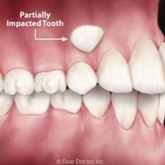 impacted teeth