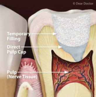 root canal treatment