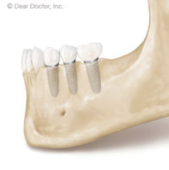 Dental Implants