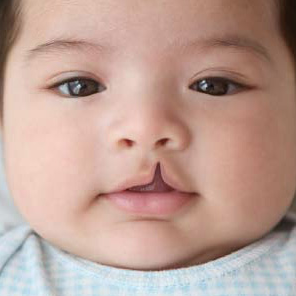 Lip or Palate Clefts