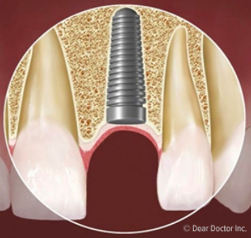 dental implant