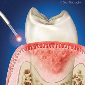 Lasers Dental care