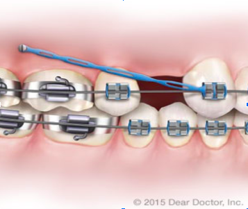 dental braces