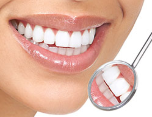 veneers