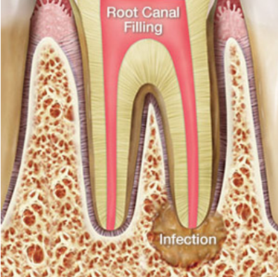Reasons Not to Delay a Root Canal Treatment