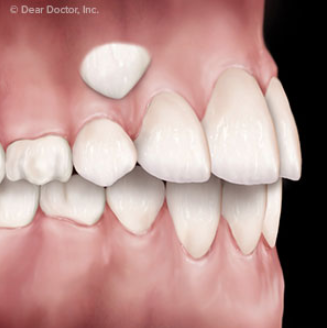 Impacted Canine Teeth