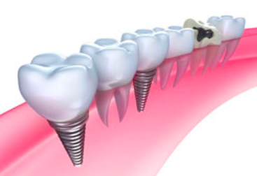 dental implants