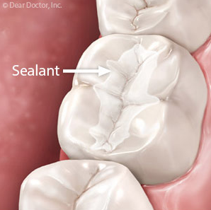 sealants
