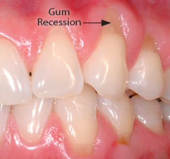 Gum recession