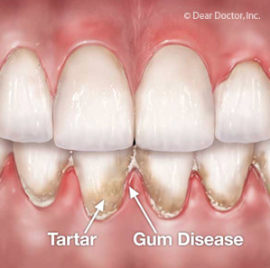 Gum Disease