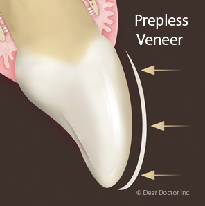 'Prepless' Veneers