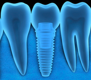 dental implant