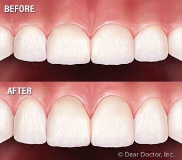 before and after crown lengthening
