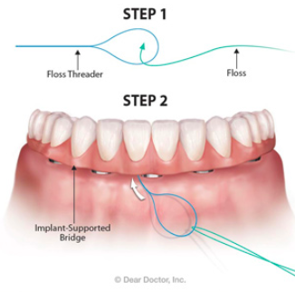 implant-supported denture