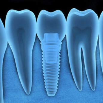 implant