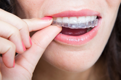 plastic aligners